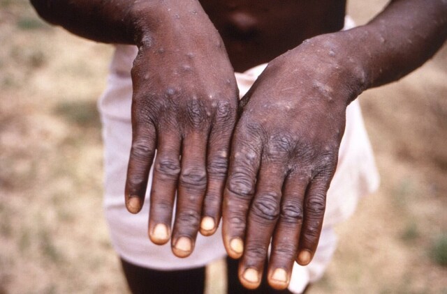Foreløpig er det bare påvist ett tilfelle av apekopper i Norge. I Den demokratiske republikken Kongo, hvor dette bildet er tatt, er sykdommen langt vanligere. Foto: Brian W.J. Mahy / AFP Photo / Centers for Disease Control and Prevention. hovedbilde